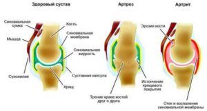 боль в суставах