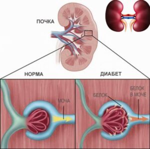диабетическая нефропатия