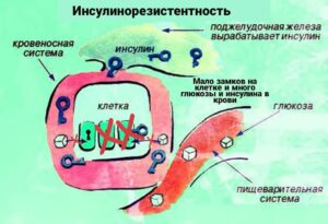 инсулинорезистентность