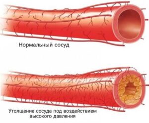 Профилактика артериальной гипертензии